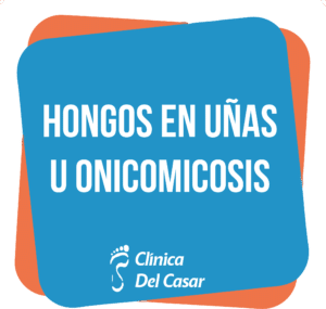 Podología, Hongos en uñas, onicomicosis