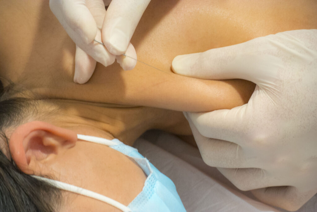 Fisioterapia en Lavapiés, punción seca